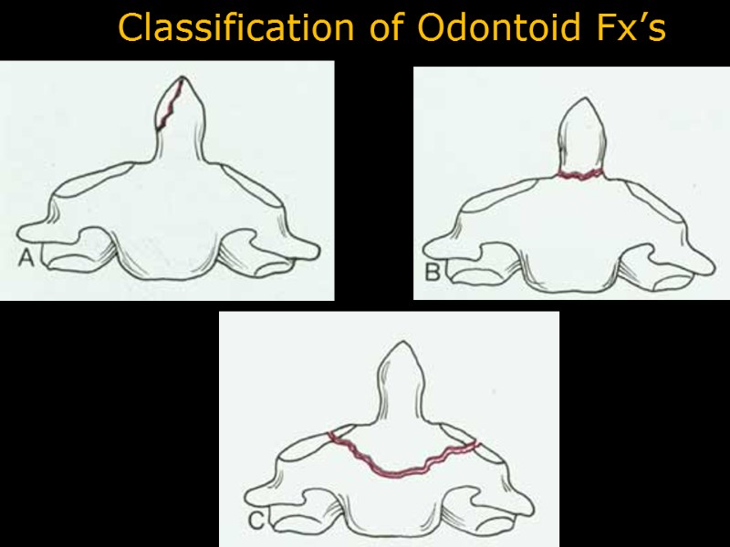 Classification of Odontoid Fx’s